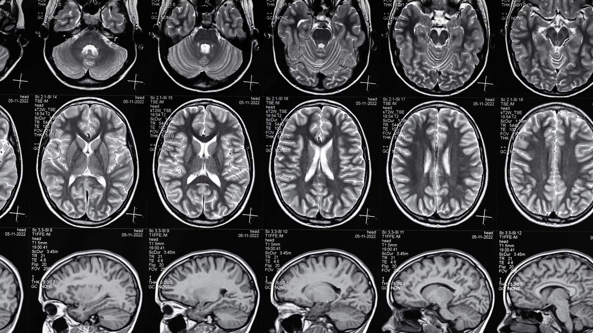 Traumatic Brain Injury Attorney in Nashville Image