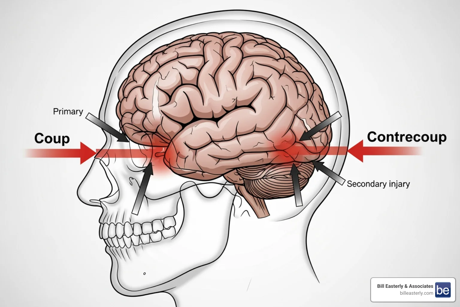 Illustration of coup-contrecoup brain injury - Motorcycle accident brain injury